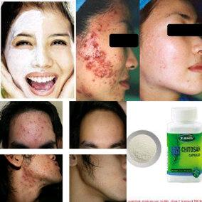 Masker chitosan utk jenis kulit sensitifmu mengobati jerawat radang ringan &amp;berat ! silakan konsultasi di 25D1547E