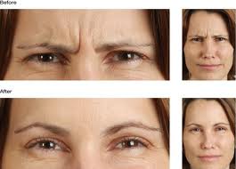 CrystalLume's tweet photo. Crystallume med spa Sale Botox $10 per unit spending $300 over $20 off more 301-418-6060 http://t.co/u0dNfgC11g