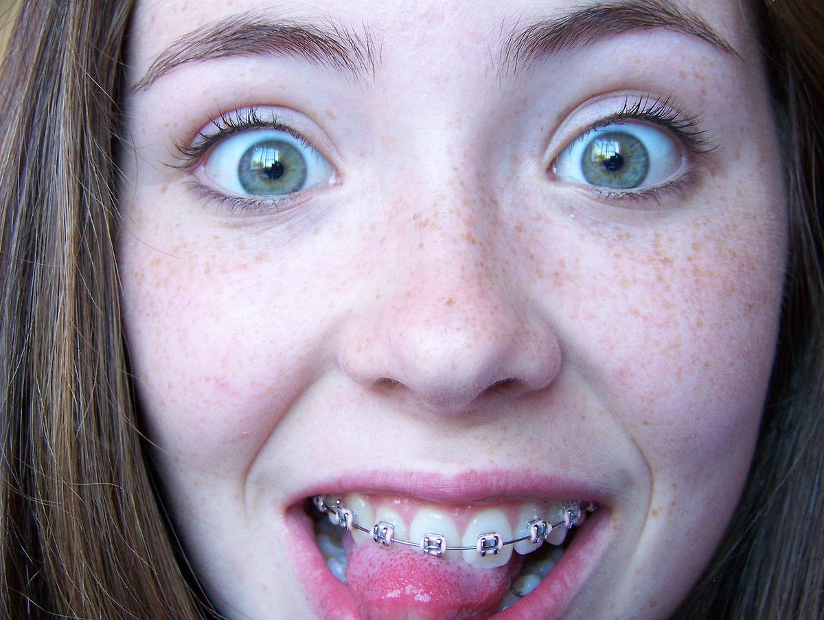 Girls With Braces Ar Twitter Cute Freckles Braces T Co 37260 Hot Sex Picture 