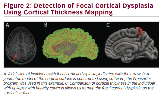 touchNEUROLOGY's tweet photo. Advanced Magnetic Resonance Imaging in #epilepsy http://t.co/p7sMt9keJp #MRI http://t.co/3ENXn0zv5G