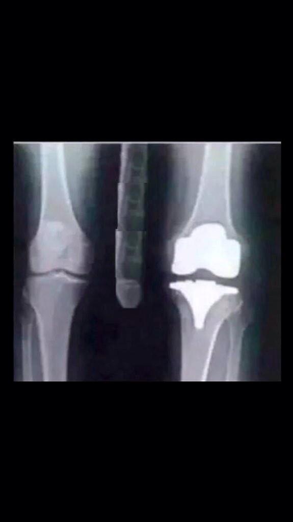 Broke my knee