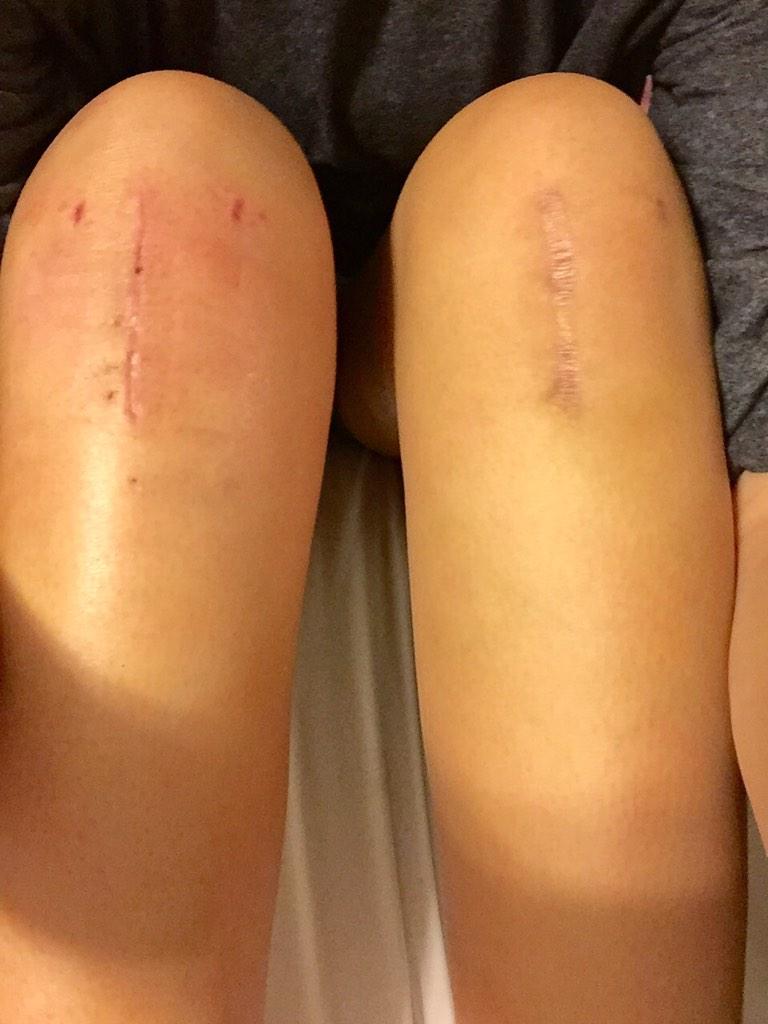 theaclreturn's tweet image. 3 weeks vs 9 months post op