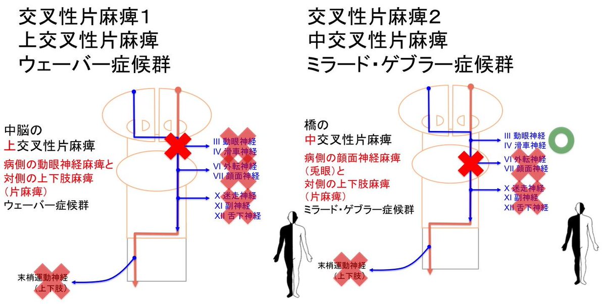 Oj 交叉性片麻痺 １ 上交叉性片麻痺 ウェーバー症候群 と ２ 中交叉性片麻痺 ミラード ゲブラー症候群 脳幹の片側性病変では 健側の片麻痺と患側の脳神経麻痺が生じる これを交叉性片麻痺という Http T Co Er6fovfi63