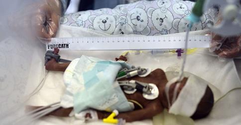 telecincoes's tweet photo. Un bebé prematuro que pesa 750 gramos, lucha por la vida> http://t.co/0FyO4wA1he http://t.co/OaZ9U2zDBA