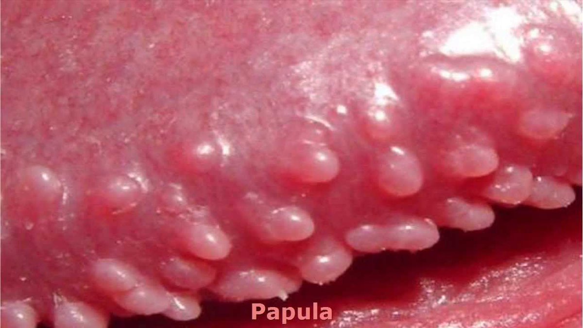 Papules pink pearly Pink