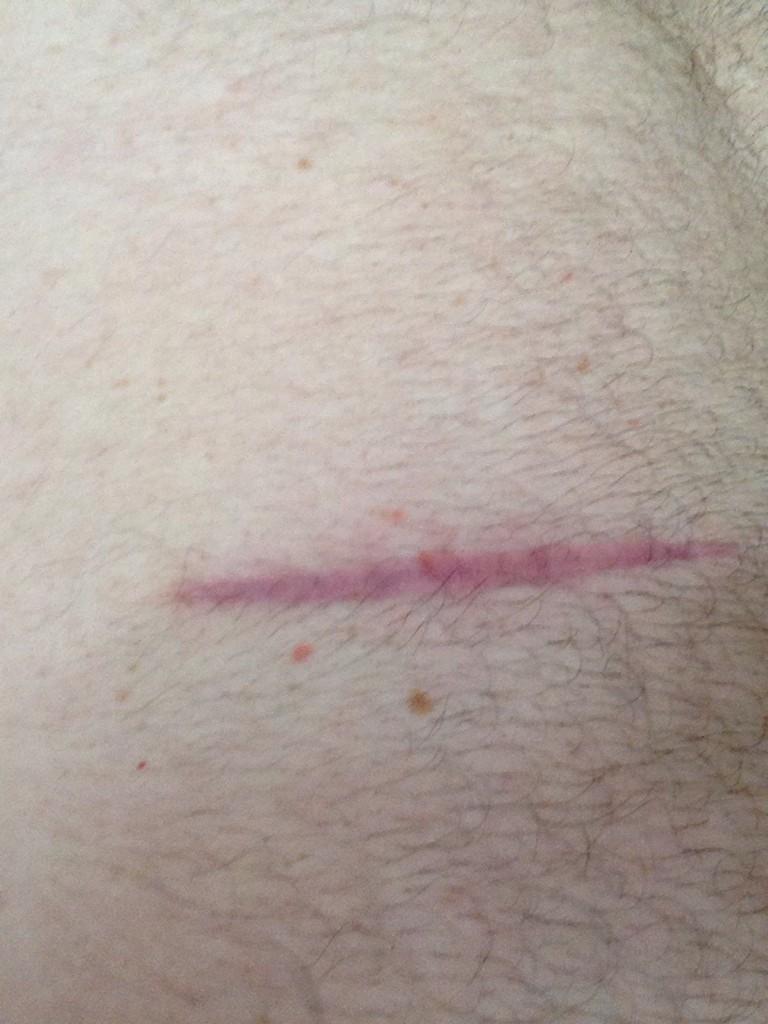 fvundsa's tweet photo. This is the 15cm scar left post the excision of a melanoma the size of a pea. http://t.co/eQyuX5sMed