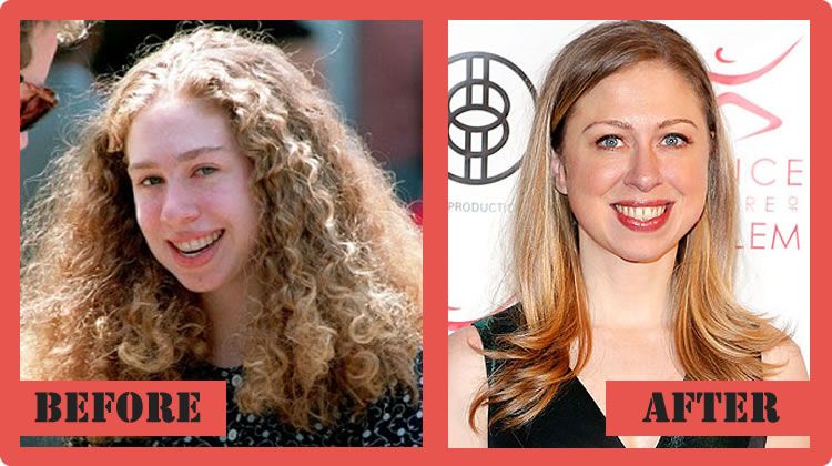 Chelsea Clinton Plastic Surgery - Has Amazingly Changed Her Looks! http://g...