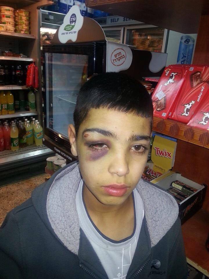 PalestineVideo's tweet photo. Photo of 13-y-o Amjad Malhi who was attacked and beaten by Israeli occupation forces in occupied Jerusalem today http://t.co/hwimFITsDa