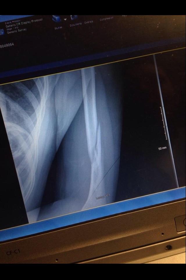 ArielBrooks12's tweet photo. Well I broke my arm in two places last night worst pain I've ever felt http://t.co/VrOkSYe18S