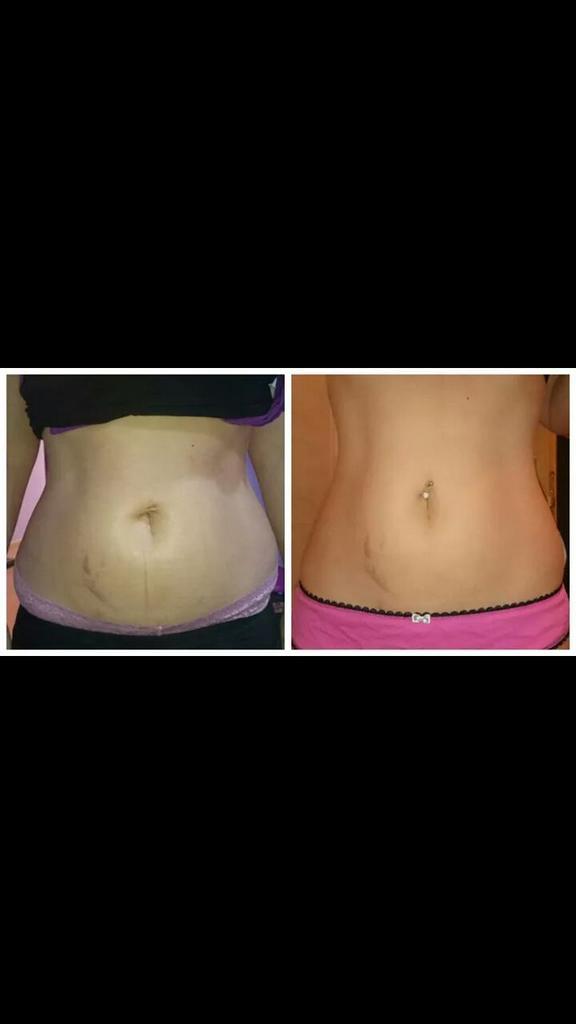 noanarroyo's tweet photo. Ejemplo del parche work con tan sólo dos sesiones, ya disponible en noan sthetic 916899839 http://t.co/JEhfIkOl1w