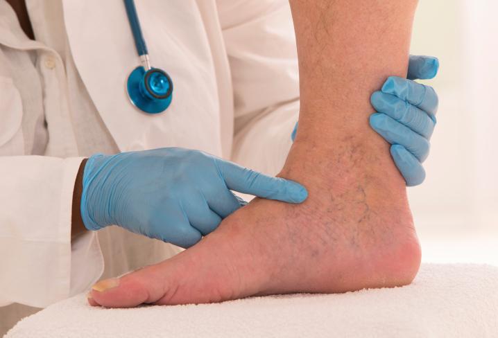 ClevelandClinic's tweet photo. Varicose veins - not just a female issue: http://t.co/xnvlnpHHz6 http://t.co/LrzKmJdAxx