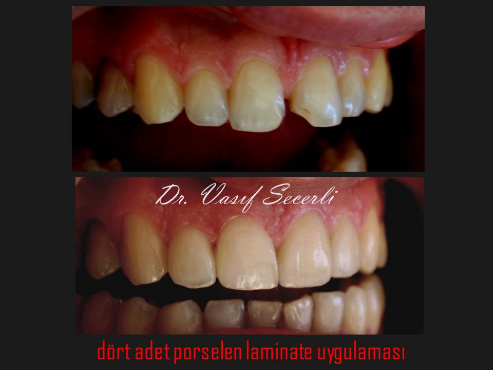 Ön dişlerde aralık kapatma...