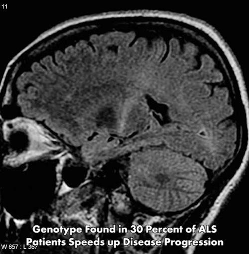 Christopher Maricle (@chrismaricle) on Twitter photo “<a href="/neuro400/">WheatonNeuro</a> : Genotype Found in 30 Percent of ALS Patients Speeds up Disease Progression neurosciencenews.com/als-progressio… ” “<a href="/neuro400/">WheatonNeuro</a> : Genotype Found in 30 Percent of ALS Patients Speeds up Disease Progression neurosciencenews.com/als-progressio… ”