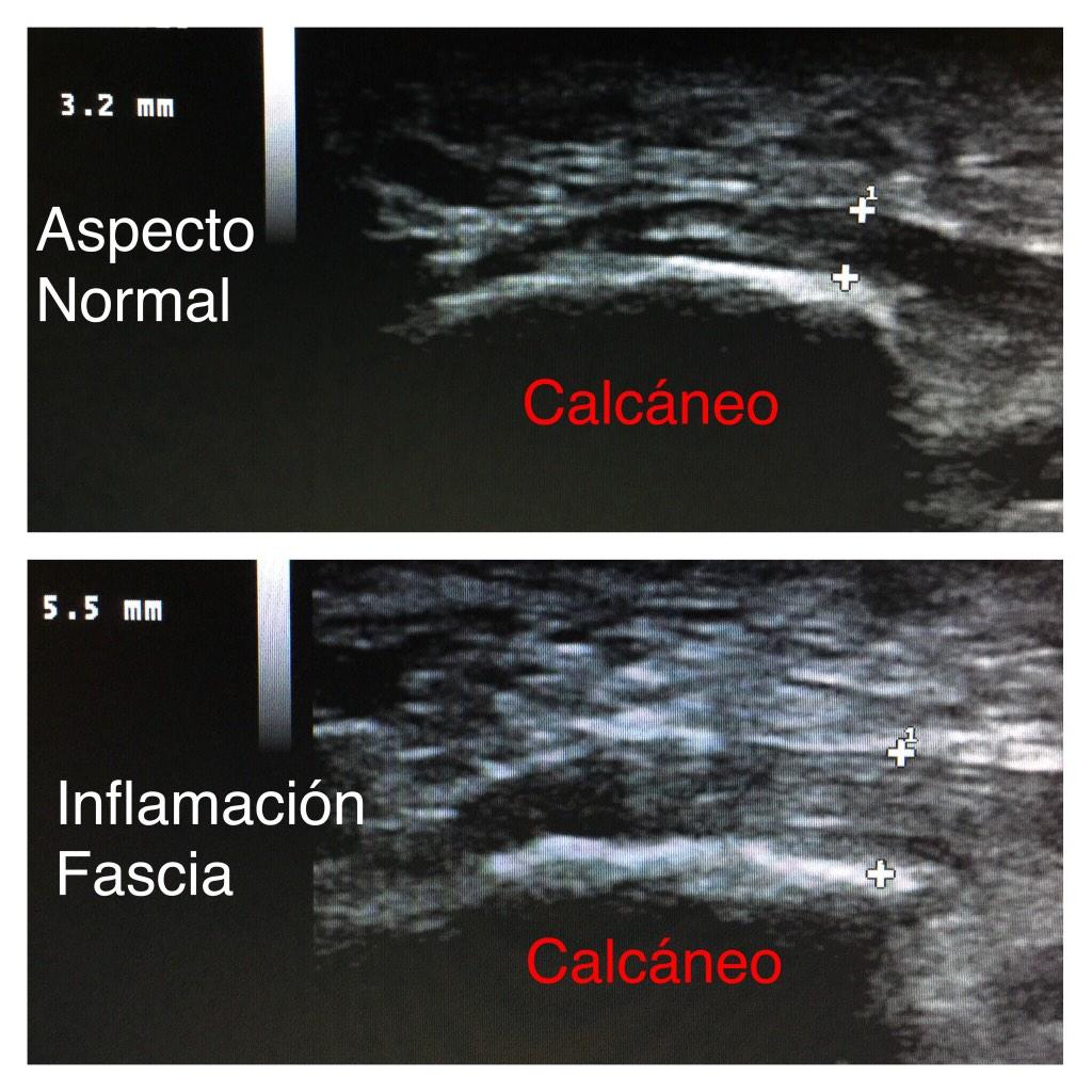 PodologoMalaga's tweet photo. Diagnostico Fascitis plantar mediante ecografía #podologia #Podólogo #podorun #podologiadeportiva #lesiones http://t.co/UK28C7IFAs