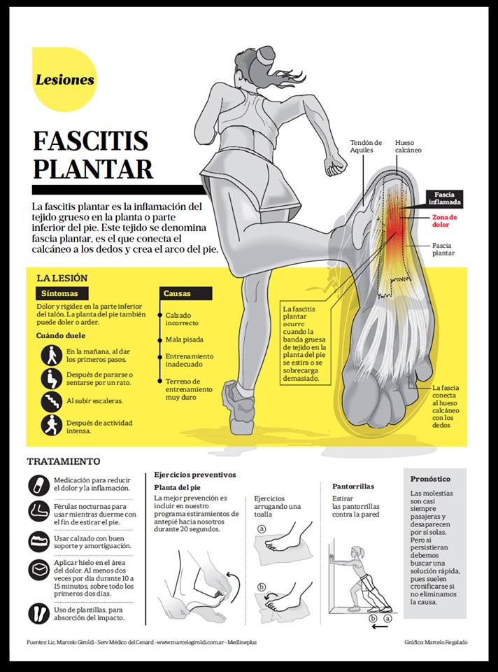 ¿Sabes lo que es las fascitis plantar? ¿Como puedes solucionarla?