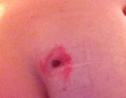 TheCrohnsRanger's tweet photo. This is your butt. This is your butt on Crohn's. Any questions? #fistula #crohns #crohnieproblems http://t.co/8wLr0sBd1G