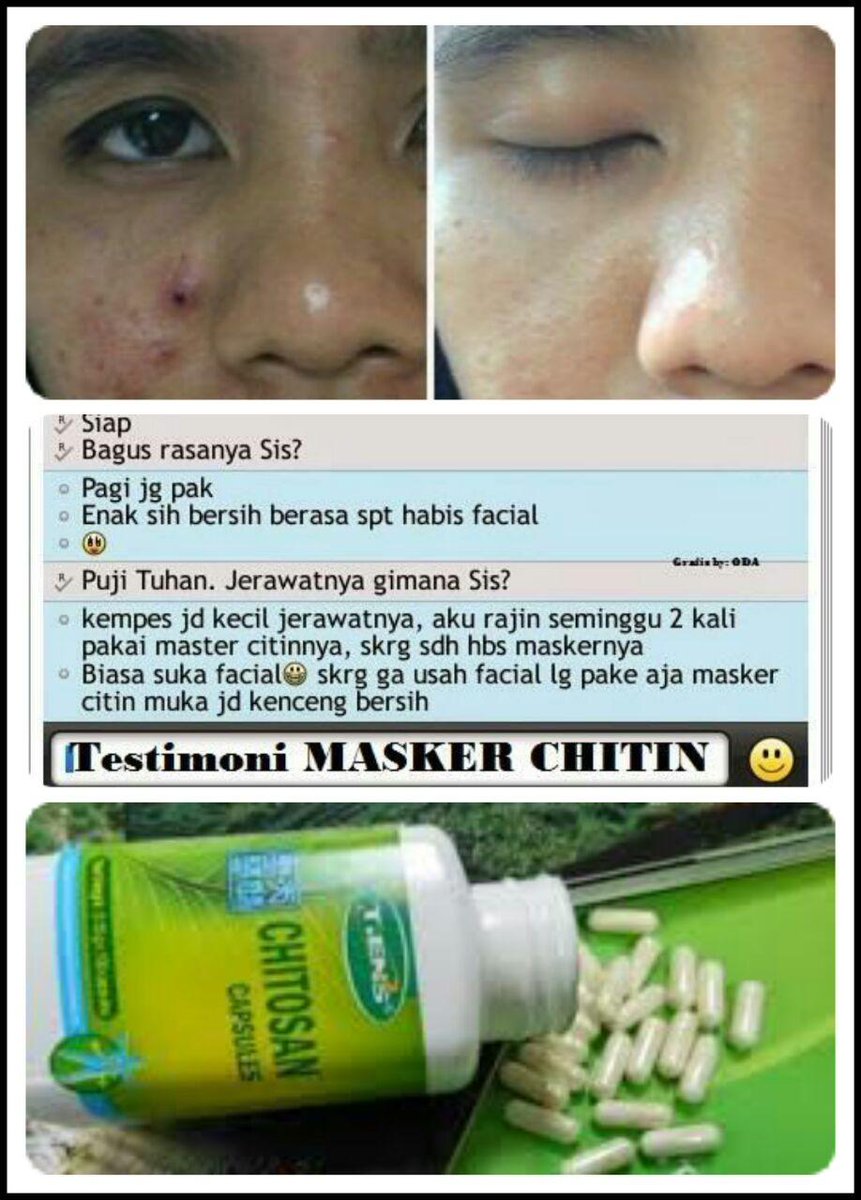 MaskerAlami_ID's tweet photo. Pengen Muka Bebas Jerawat Gampang,Ayo Coba Masker Herbal Chitinnya sekarang juga! Pin: 26A443F0, Hp 0822 1410 179 http://t.co/MfSg0bp3LT