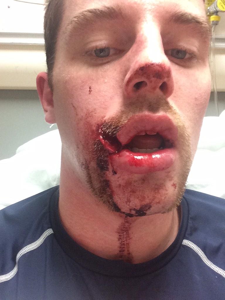 colbylanceleve's tweet photo. Gongshow beauty weapon @jessemacinnis blocking shots with his face http://t.co/1HEX8DMqa5