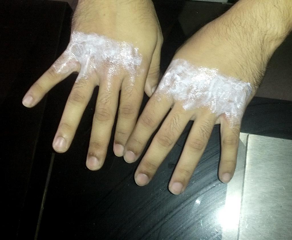 Internal Bleeding Hand