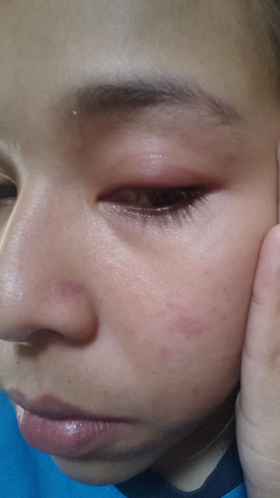 RaisaWisnu's tweet photo. masih alergi 😢😢😢😢 http://t.co/SLcHOiL67V