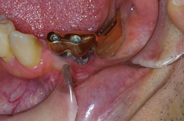 drglants's tweet photo. Dental Implants Maintenance! Read more: http://t.co/PBIRJeEBlj | #dentistry #cosmeticdentistry #dentalcare http://t.co/QtzZ1nBeod