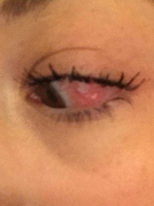 Got some prescription drops to get rid of this icky eyeball !! So sorry i havent been on cam guys.. But<a href="/tag/corvette"class="tags"><span>#corvette</span></a><a href="/tag/c7"class="tags"><span>#c7</span></a>