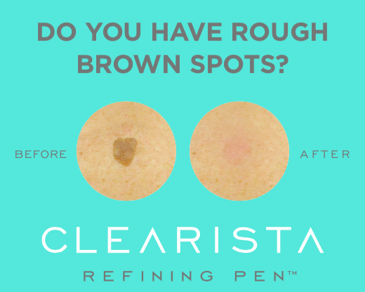 Clearista's tweet image. It's #transformationtuesday! Have brown spots? Take a look at some before/after photos with the #clearista pen.