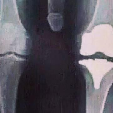 “@DJFreshSA X-rays of my knee replacement #painful” .