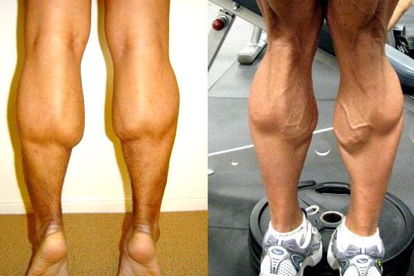 Почему забиваются ноги. Миозит икроножных мышц. Мышцы икры ног. Икроножная мышца. Икроножные мышцы до и после.