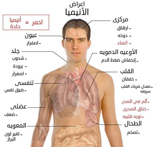 MedicalGerman's tweet photo. اعراض #الانيميا http://t.co/gkSeLpPFbb