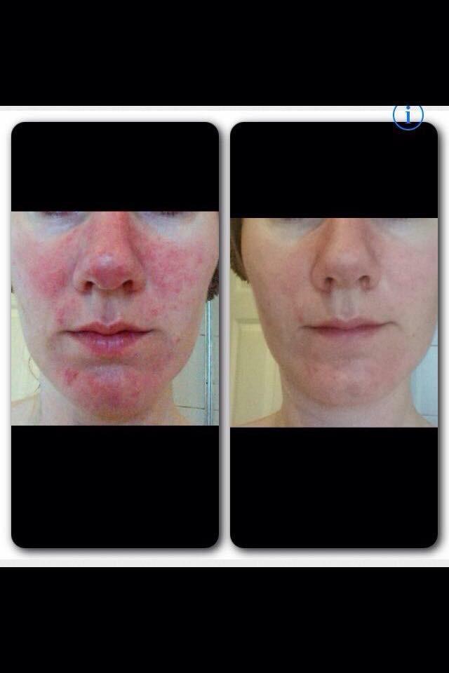 arbonne rosacea