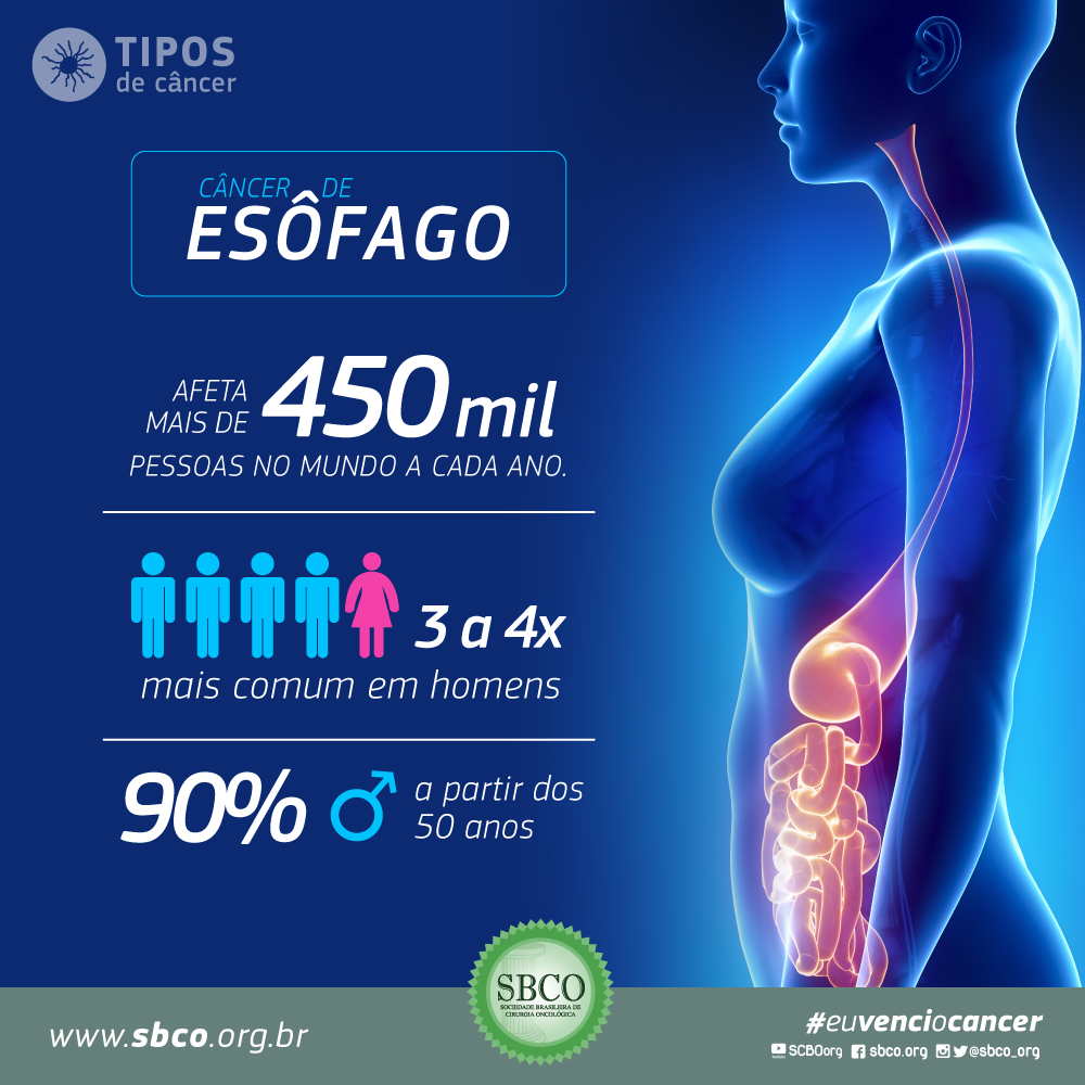 sbco_org's tweet photo. O câncer de esôfago afeta +de 450mil pessoas no mundo por ano. Mais informações acesse http://t.co/ihzxB2rZoR #sbco http://t.co/zUm4R2jost