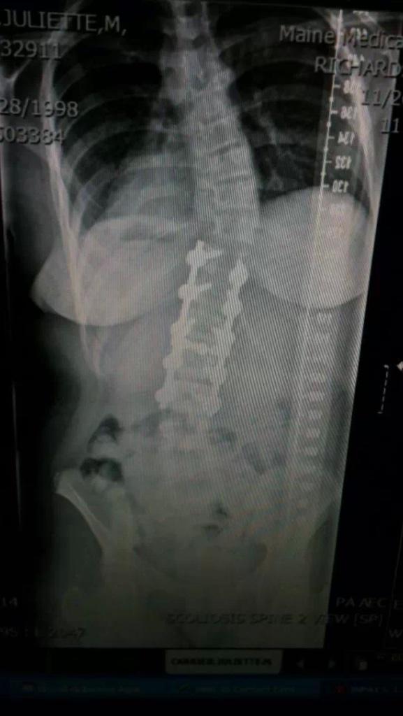 JMCarrier_'s tweet photo. Three years post op of my spinal fusion.. From "broken" to holding powerlifting state titles 💪 @wearefitfam @swoleu http://t.co/TzIDLW0idv