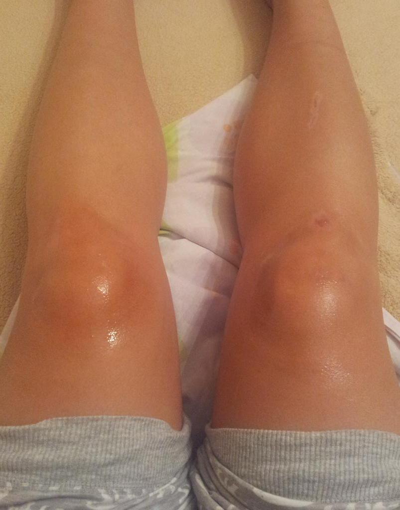 mariiia_7's tweet photo. Que correr es bueno? Las rodillas mas destrozadas de todos los tiempos os dan las buenas noches!! #MeMueroDeDolor😭😭 http://t.co/qZqjyKBVvL