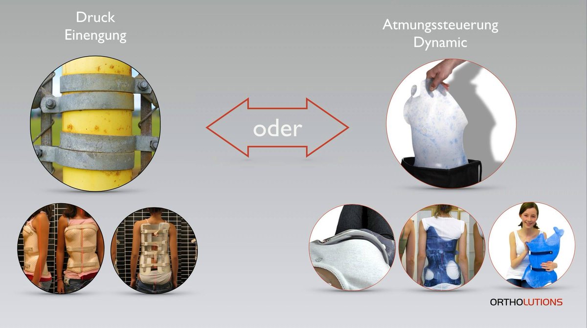 Ortholutions_JS's tweet image. What do you prefer? 
...feeling cramped like a sausage or free with the possibility to breath in your brace?