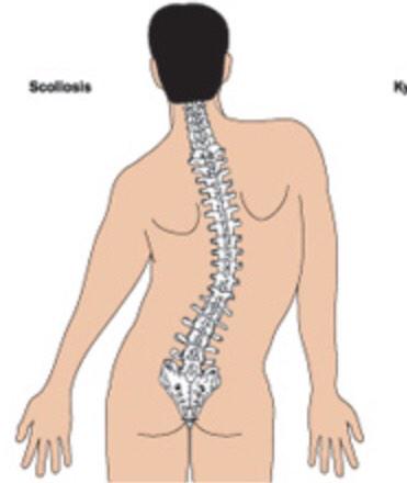 mariaaa_lopezzz's tweet photo. @mikescoli has scoliosis #tweakinghoe http://t.co/b3PXF9kdMX