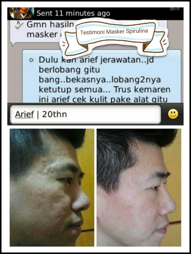 MaskerAlami_ID's tweet photo. Wajah bolong-bolong aja bisa sembuh pake masker spirulina loh!!! yuk Invite Pin: 26A443F0 , HP 0822 1410 1791 http://t.co/hNGGdgjGNc