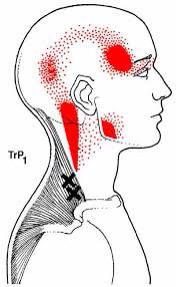 Спондилёз шейного отдела позвоночника что это такое. Упражнения чтобы убрать второй подбородок. Давит шею и уши. Самомассаж трапециевидной мышцы. Давит шею и уши.