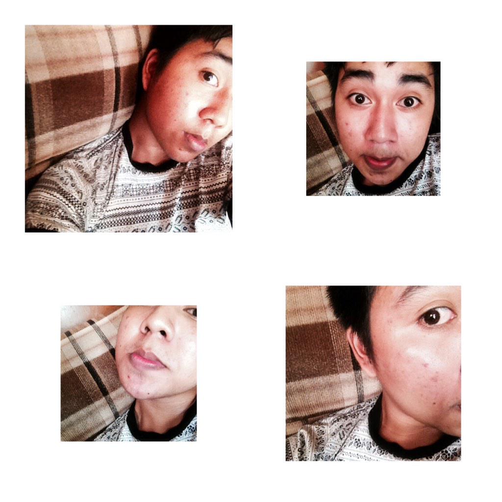 lilyolkiez's tweet image. #PimplesProblems 😞😭💔