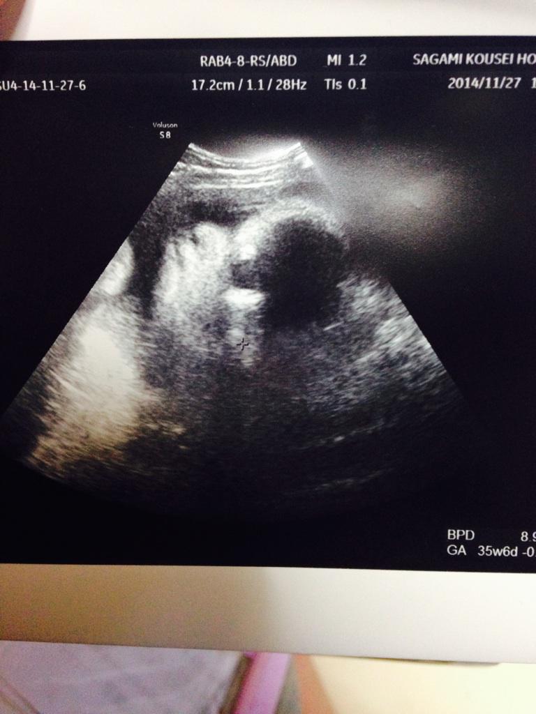 ゆう 昨日のエコーの写真なんだけど 上向いてるんだけど猿みたいww 口めっちゃタラコじゃね とか病院内で話してたんだよねwwこのエコーの顔超ブス とか言ってwwもーブスすぎて可愛い 光仕事行ってらっしゃいした Http T Co Rgvord5sad