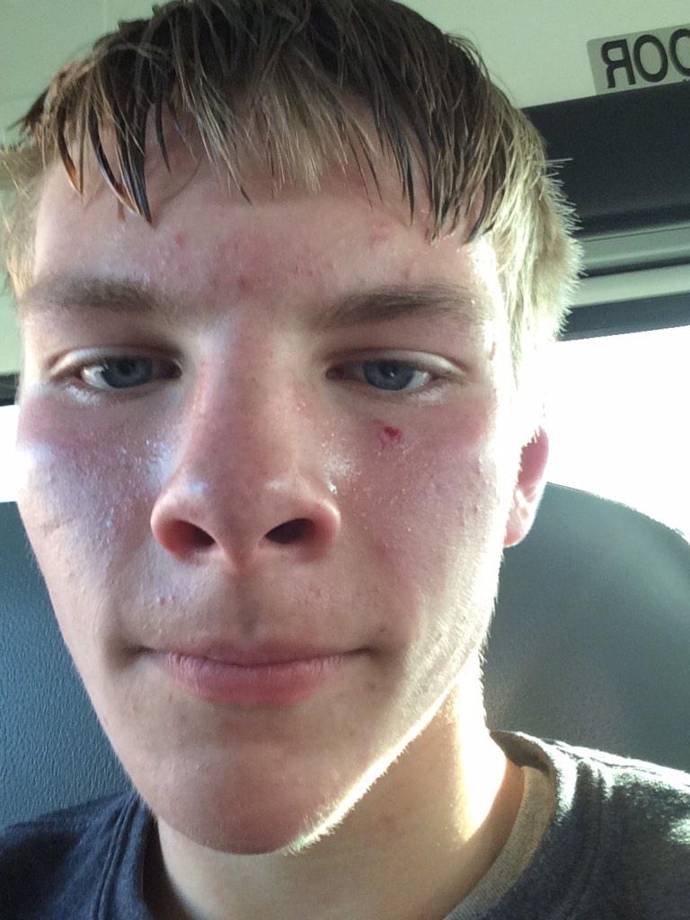 ____MattHiggins's tweet photo. Look at this massive gash @NStoney23 gave me. #viewerdescretionisadvised http://t.co/m4bhkRKyV3