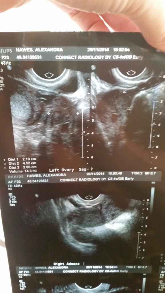 HawesAlly's tweet photo. Six weeks and 2 days pregnant. http://t.co/mGOZPMjVo2
