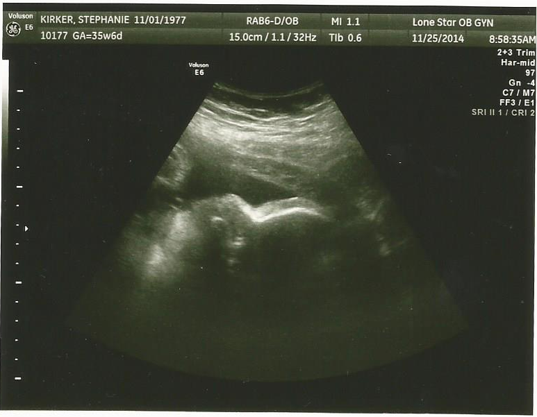 neilsite's tweet photo. Here is a picture from our baby's ultrasound on Tuesday, November 25th (visit Our Baby's Site for more updates!) http://t.co/TnZTkgA96y