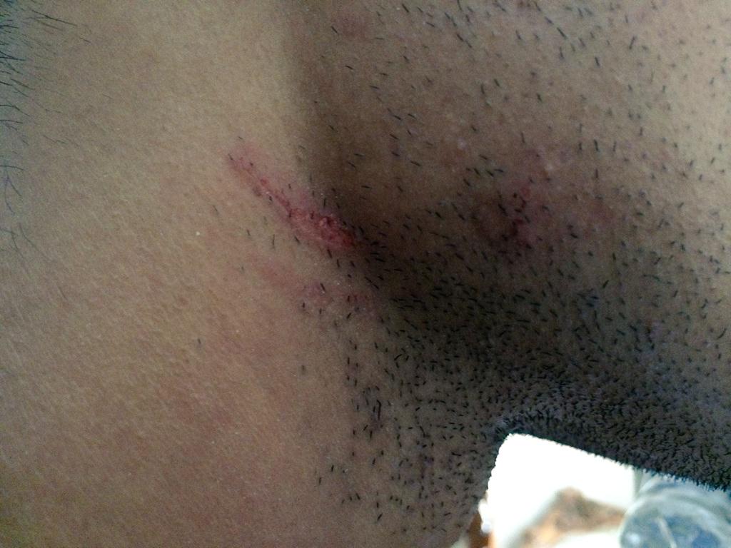 vinrana1986's tweet photo. I love you so much plz don't scratch me!  Scratched by a fan! http://t.co/giod7V4ZLR