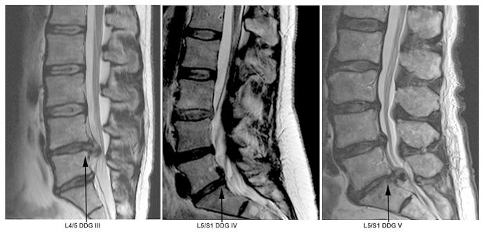 Disc degeneration, endplate change and Schmorl's node in LBP - Spine J 2014: buff.ly/1Abj8eX