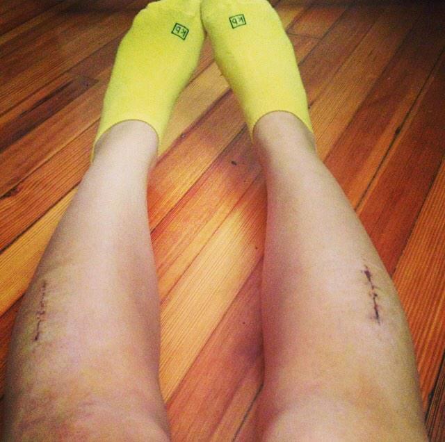 erikaflowerss's tweet photo. Scars only prove that you are stronger then what tried to defeat you. #FourWeeksDown ๐ http://t.co/m4WEqFAFmv