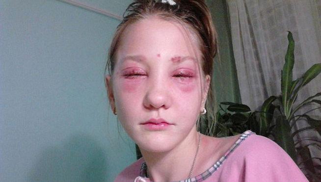 informativost5's tweet photo. Una joven rusa, parcialmente ciega por usar un tinte de pestañas de menos de 4 euros http://t.co/qrhgyPwOn0 http://t.co/hECo9OpzUY