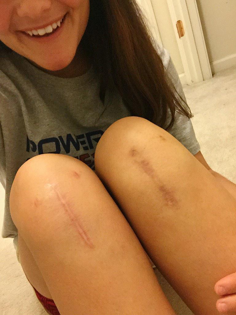 theaclreturn's tweet image. "Scars are beautiful, in a way. They show what you've been through and how strong you are for coming out of it."