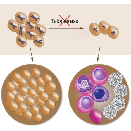 Telomerase inhibition can eliminate AML leukemic stem cells (w/primary human cells) bit.ly/1AmqjBv