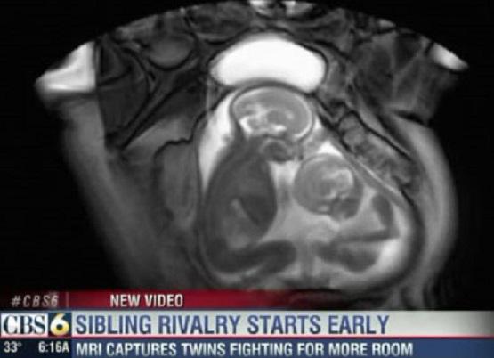 NoMoreChange's tweet photo. Twins fighting in the womb. If they are #fightingForLife we should too! #prolife  http://t.co/77AjXnU0Kw